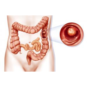 2. Tác dụng chữa bệnh liên quan đến tuyến tính, trực tràng